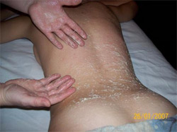 Medová masáž
